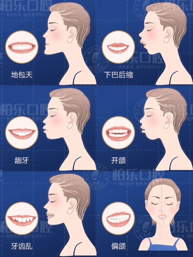 此公益行动主要针对地包天,下巴后缩,龅牙,开颌,偏颌,牙齿不齐等牙齿