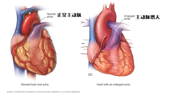 a动脉夹层破裂_动脉夹层破裂a型怎么治_冠状动脉夹层破裂什么意思