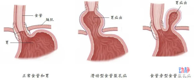 食管裂孔疝图示