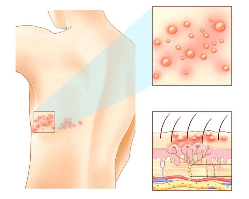 带状疱疹图片卡通图片