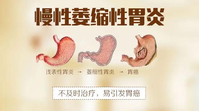 慢性萎缩性胃炎可能属于癌前状态,癌变风险较高,症状多为上腹痛,腹胀