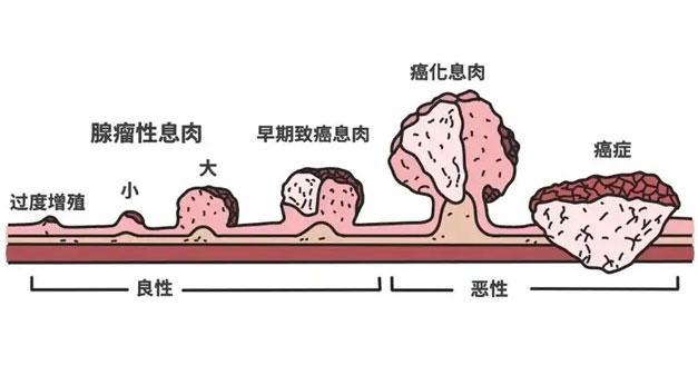 被你忽视的常见病很可能是癌前病变