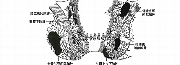 肛管直肠周围脓肿图片