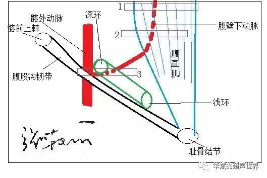 腹股沟管内环图片