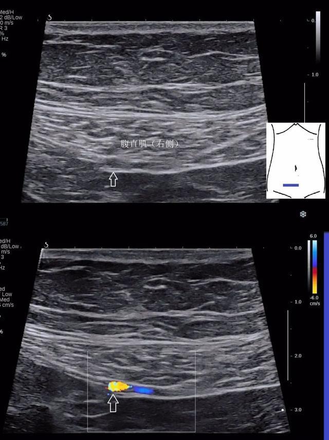 腹腔大血管解剖图超声图片