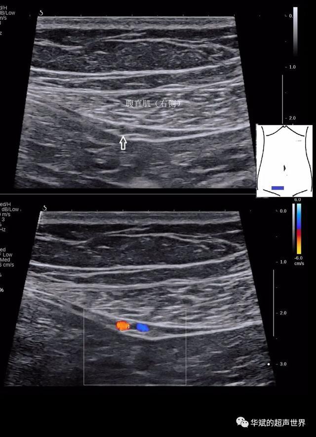 超声解剖61腹壁下动脉与腹股沟管内环