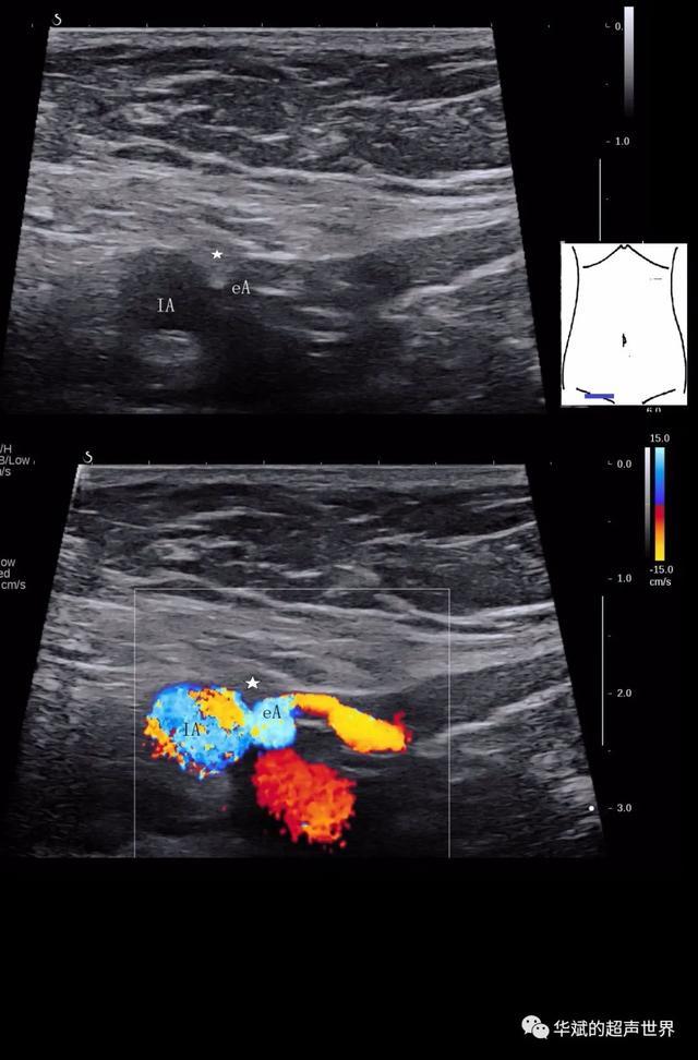 超声解剖61腹壁下动脉与腹股沟管内环