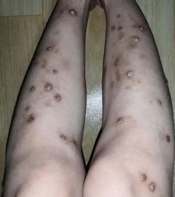 两条腿上都是剧痒的"肉疙瘩",我挠得指甲缝里都是血污_腾讯新闻
