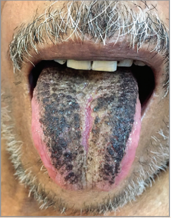 舌头上长黑血泡是癌症图片