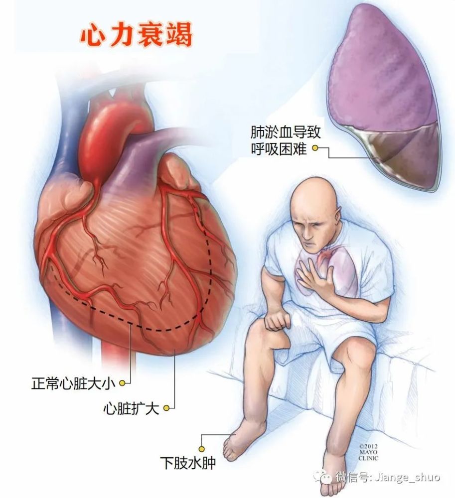 心输出量减少 腾讯网