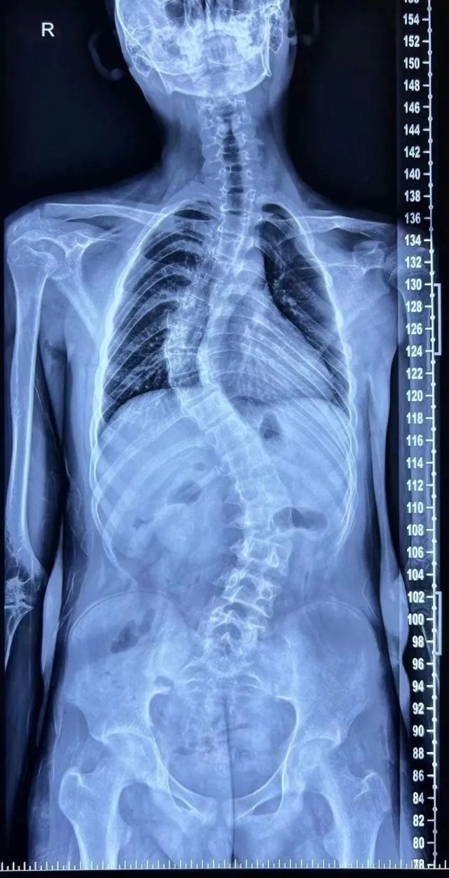 14岁男孩脊柱侧弯60度医生术后长高6公分