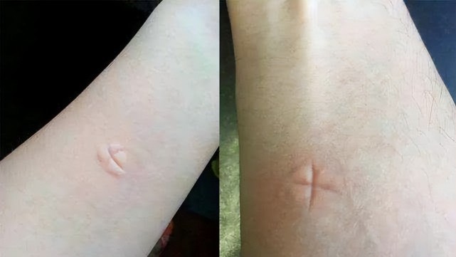 鸡皮肤更招蚊子吗(皮肤特别招蚊子怎么回事)