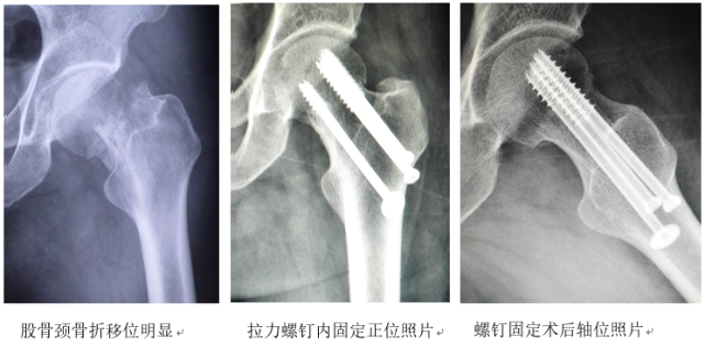 以案说医彭力平治疗股骨颈头下骨折经验