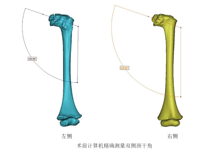 儿童髋关节颈干角增大图片