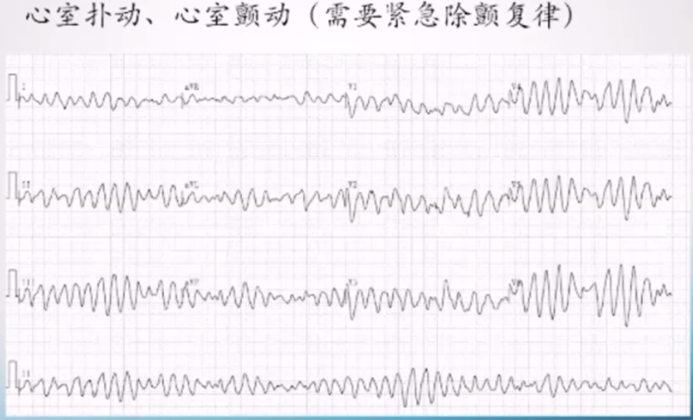 牢記心電圖8大危急值搶救高危患者快人一步