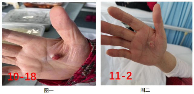 2 患者因治疗需要再次返院,返院时患者手掌新生物由之前的红色开始