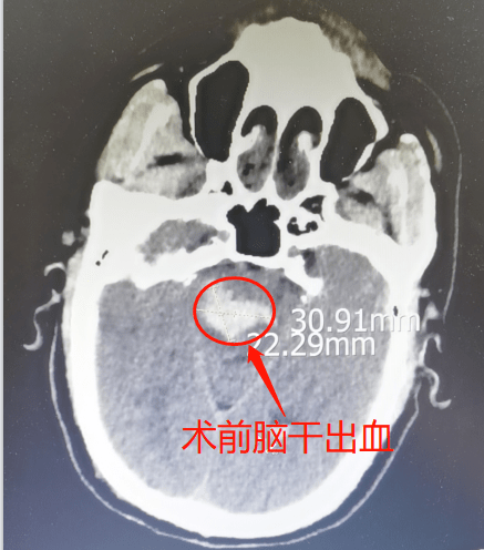 脑干出血命悬一线神外医生勇闯禁区患者奇迹苏醒