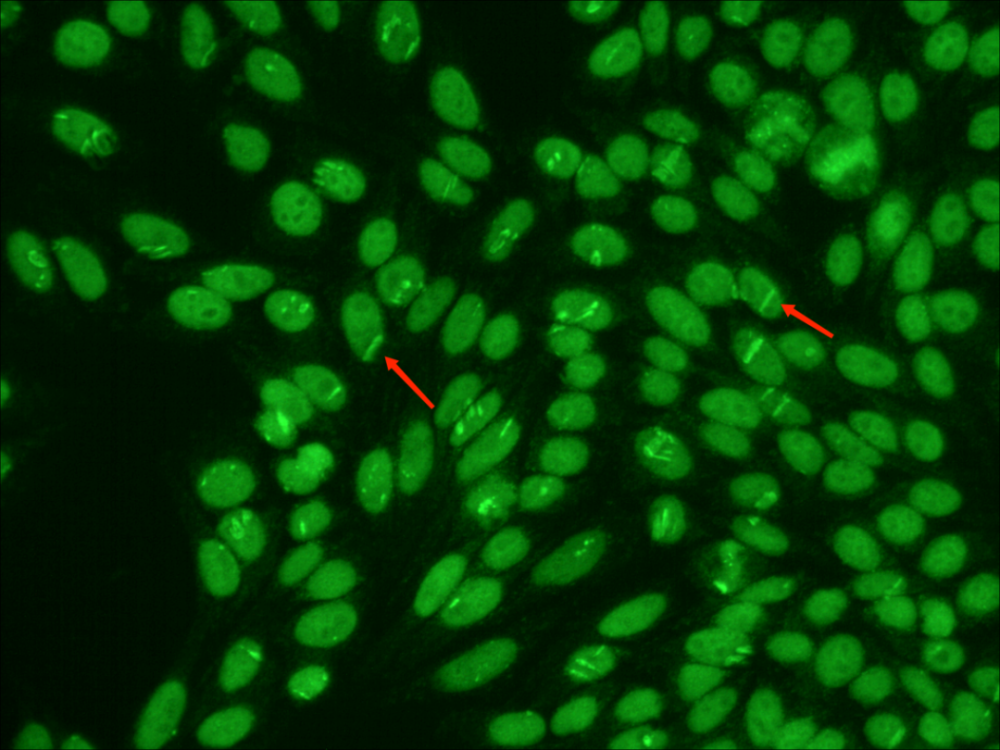 一例"肚脐样"抗核抗体核型引发的关注_腾讯新闻