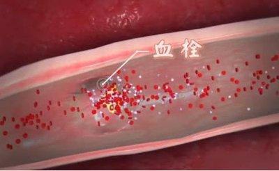 透明血栓主要在静脉内大,多为新鲜的血栓,显微镜下观察可以看到纤维