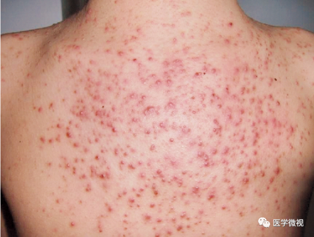 "小疙瘩",有的上面顶着一个脓头,有的比较光滑,而且有瘙痒症状的时候