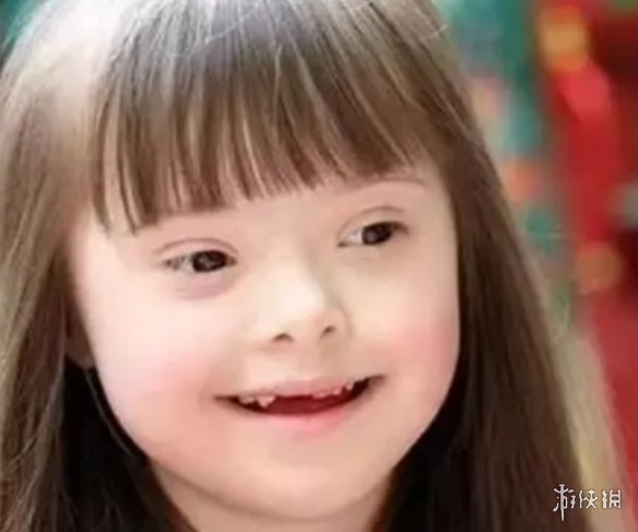 这其实是唐氏综合征(21三体综合征)患者外表的常见表现.