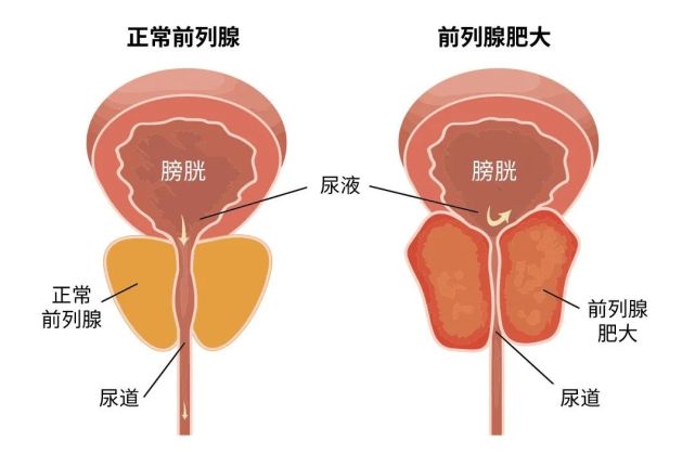 前列腺增生示意图图片