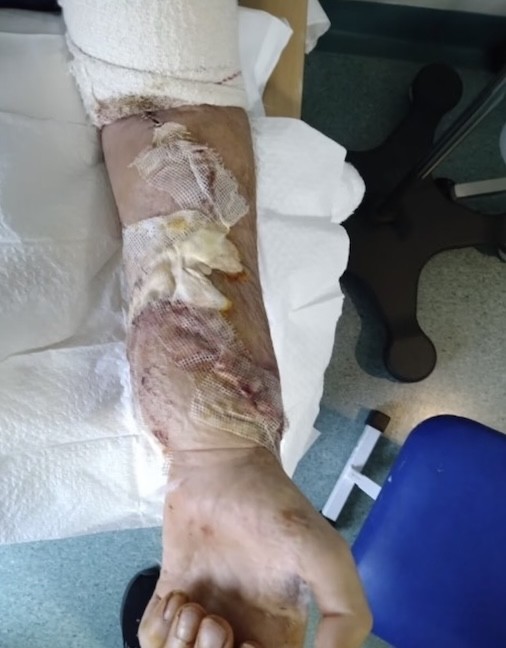 苏格拉男子患怪病后双手石化成拳头移植别人的双手后终于能动了