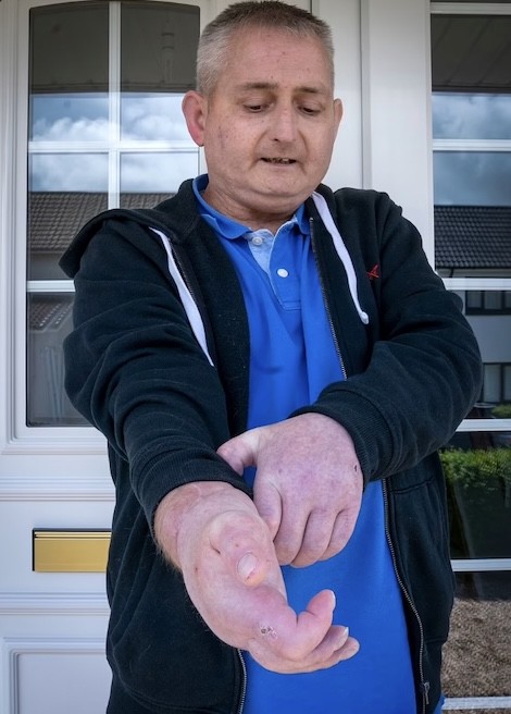 苏格拉男子患怪病后双手石化成拳头移植别人的双手后终于能动了