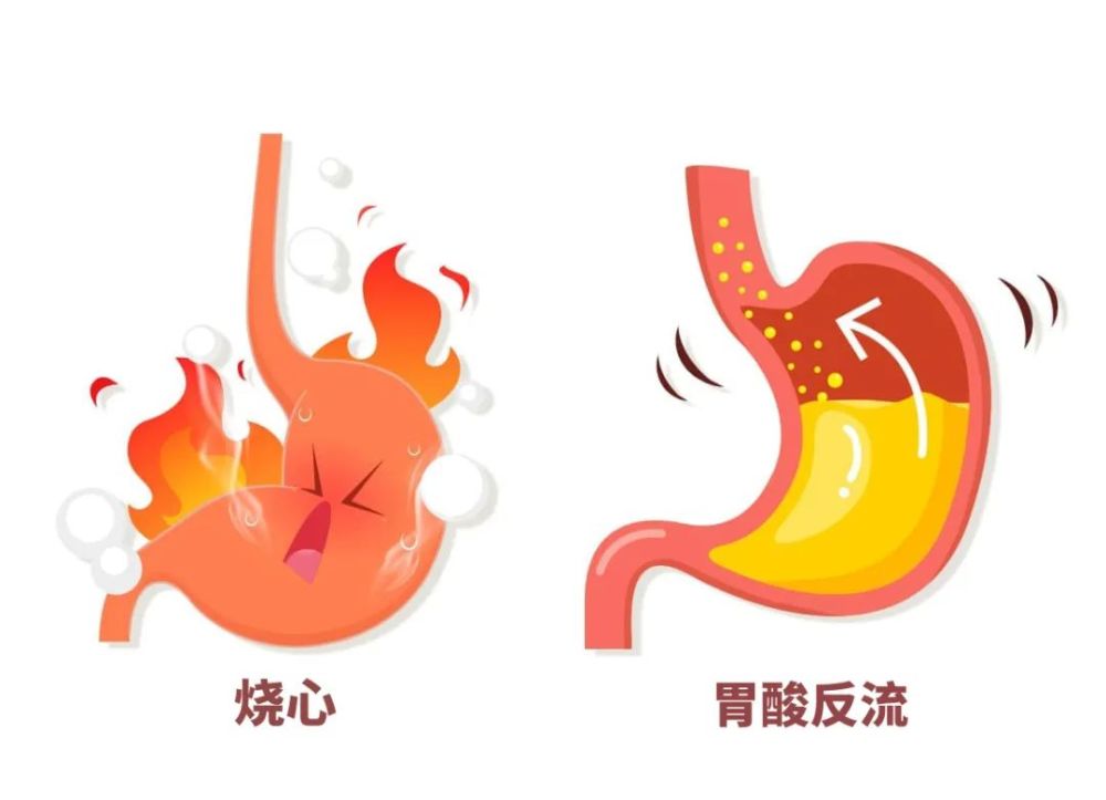 許多反流性食管炎的患者來門診時,和我講述的症狀原因大多是因為賁門