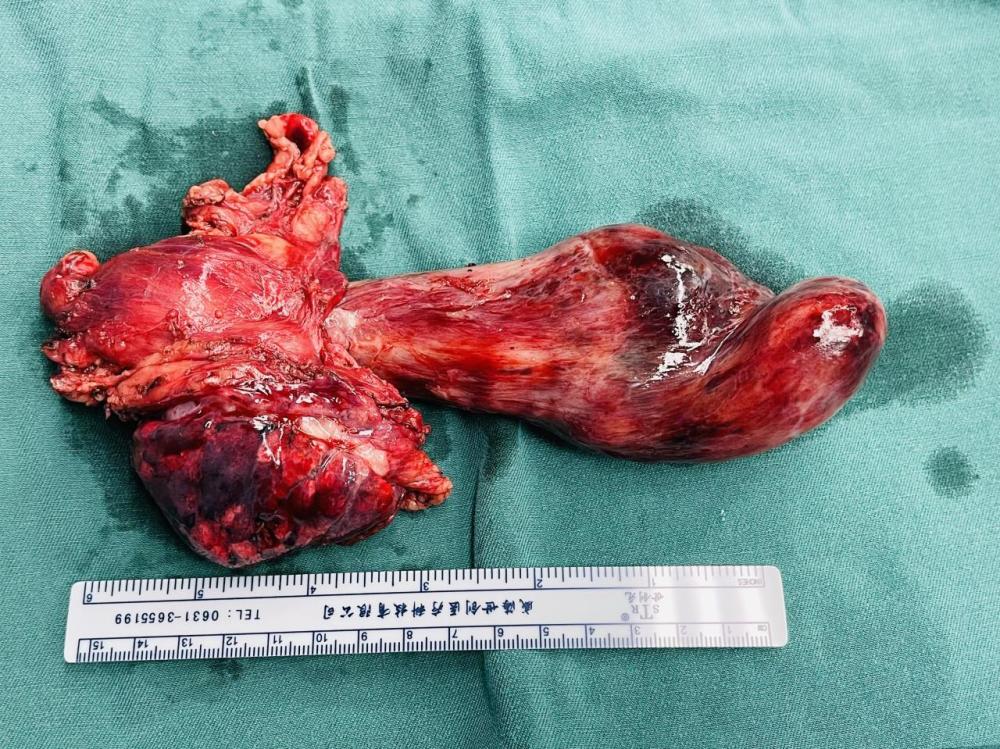 广东首例报道巨大胸腺瘤手术在深完成