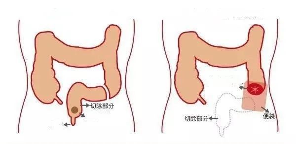 得了直肠癌一定要做人工肛门?no!