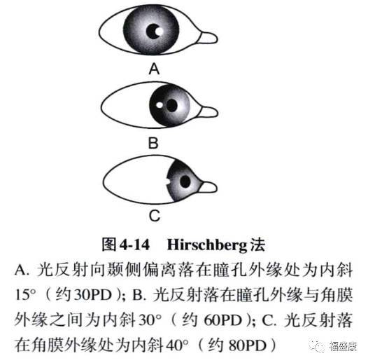 光反射向顳側偏離為內斜視,向鼻側偏離為外斜視,向下方偏離為上斜視