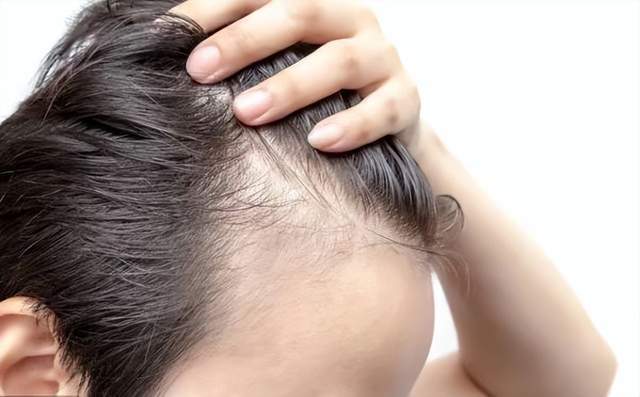 熬夜抑郁会造成脱发吗带你认识脱发的六大原因