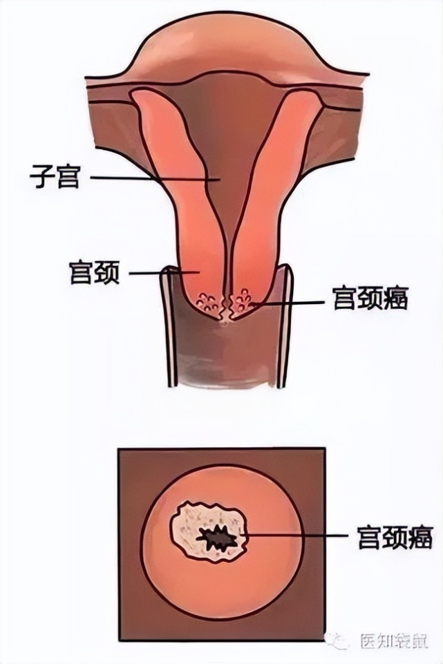 25岁以下女孩到底有没有必要进行宫颈癌筛查?