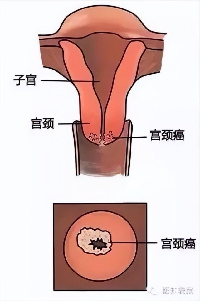 宫颈癌的宫颈图图片