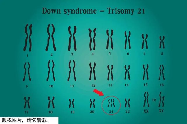 唐氏综合征即21-三体综合征,是由染色体异常(多了一条21号染色体)而