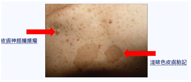 关注病神经纤维瘤 守护"牛奶咖啡斑"人群_腾讯新闻