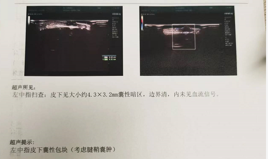 每日双击截屏数百次女子腱鞘囊肿引发肿瘤疑云