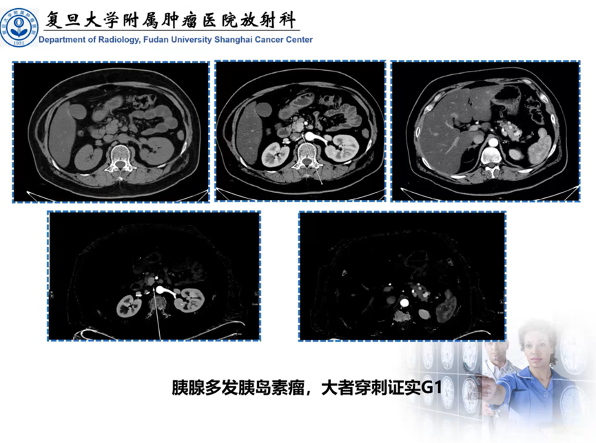 胰腺粘液性囊腺瘤07囊性為主:胰腺導管內乳頭狀粘液瘤08什麼胰腺囊性