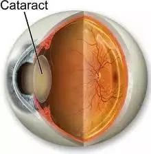 后发障是什么解读白内障手术后又看不清的真相