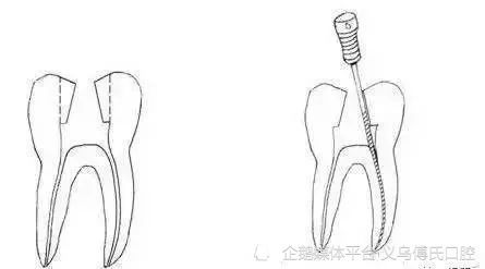 五個不同牙位的開髓改良操作義烏傅氏口腔