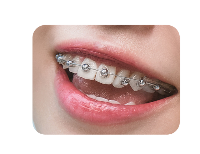 球面自锁托槽,球托舒适化矫正怎么护理