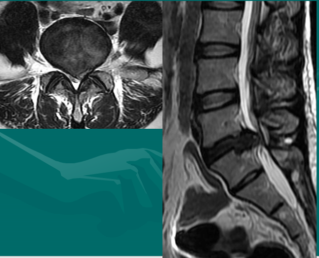 骨科精讀腰椎間盤病變的mri診斷你都掌握了嗎