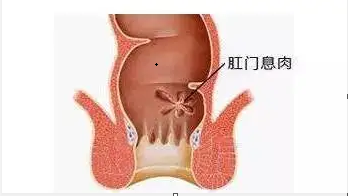 温州医博肛肠医院肛门息肉的症状是什么