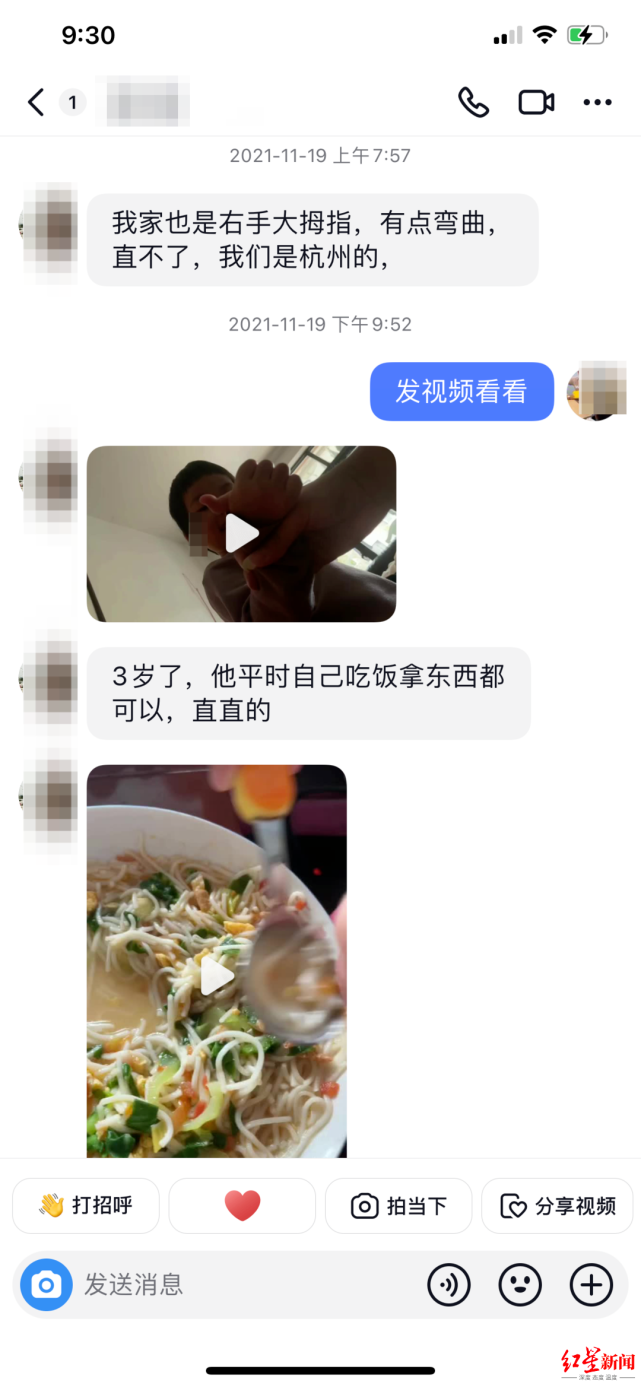唐流刚主任中医师说,儿童腱鞘炎,是一种小儿常见的