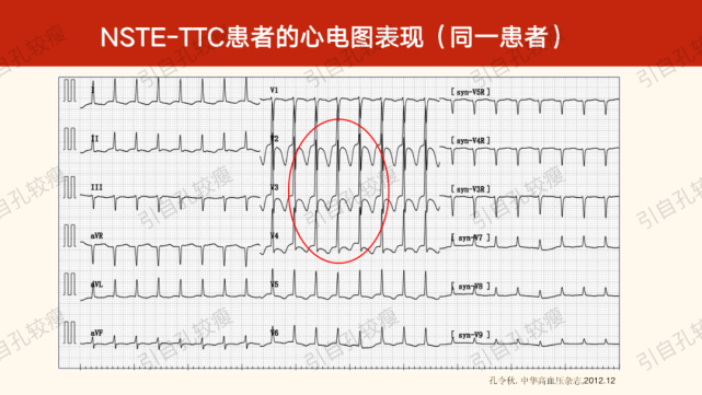 孔较瘦:takotsubo综合征有哪些心电图表现?