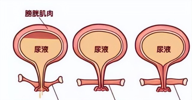 女性膀胱孕妇图片