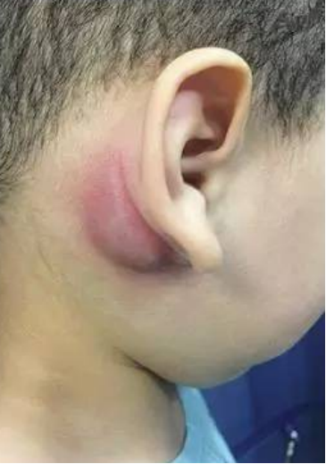 医生考虑是囊肿复发,再次做了囊肿切除手术,1年后,成成颈部的囊肿又