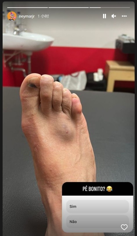肿起一块内马尔晒受伤肿胀的脚背:好看吗?_腾讯新闻