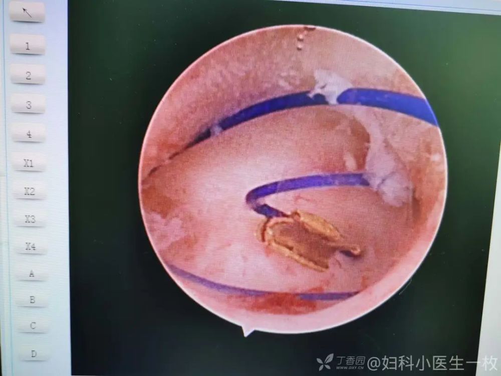 上吉尼环 15 年,此次异常子宫出血可要归因于此?_腾讯新闻